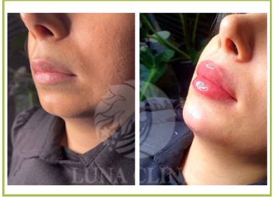 تزریق ژل لب در اصفهان | دریافت نوبت: 09190231250