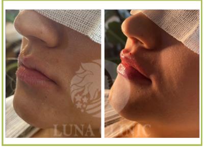 تزریق فیلر لب در اصفهان | lona clinic