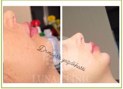 اصلاح فرم چانه در اصفهان | دریافت نوبت: 09190231250
